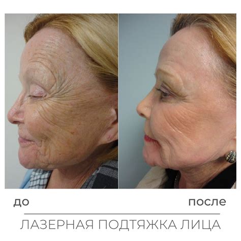 Пунктурное омоложение лица в Москве - новый взгляд на уход за кожей